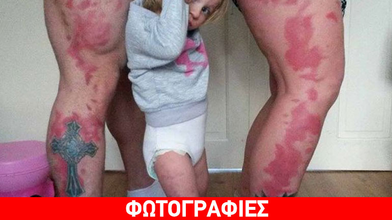 Γονείς έκαναν τατουάζ τα σημάδια της κόρης τους